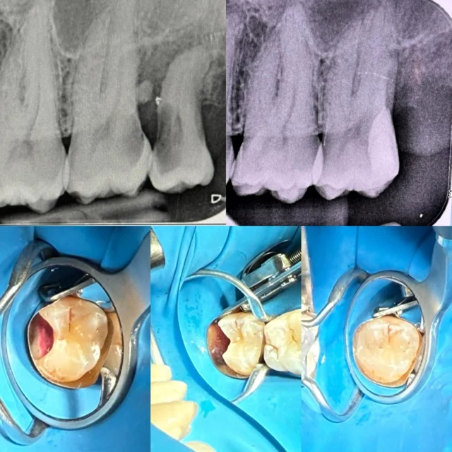 Let’s use all the tools I have to treat that tricky cavity 😅😅😃😃
#dentist #rubberdam #beforeandafter