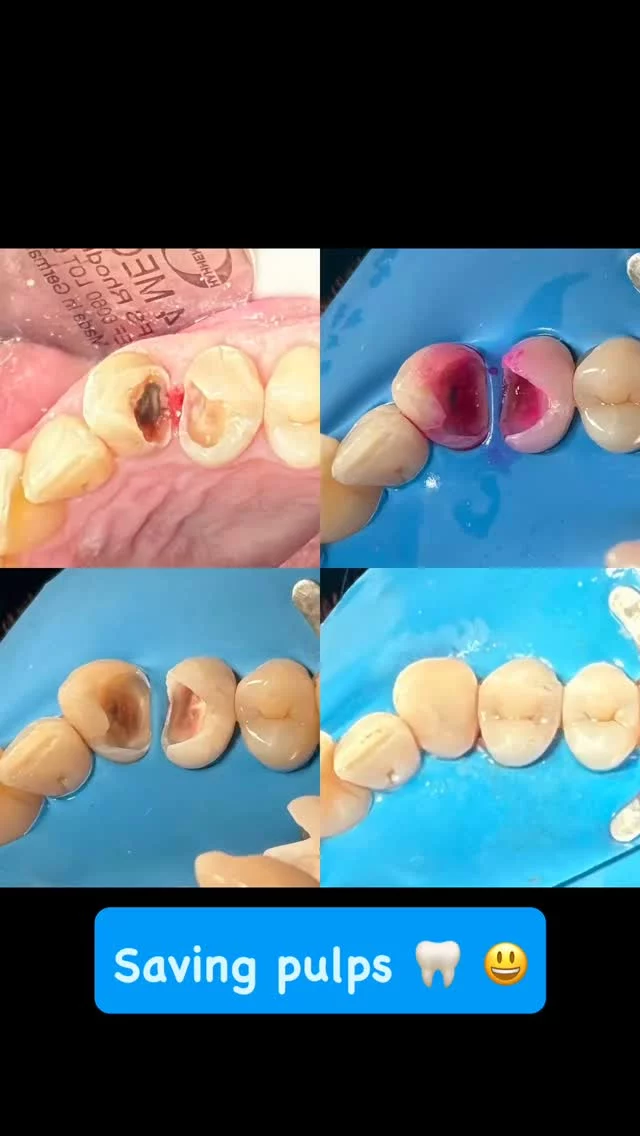 #dentist #beforeandafter #photooftheday